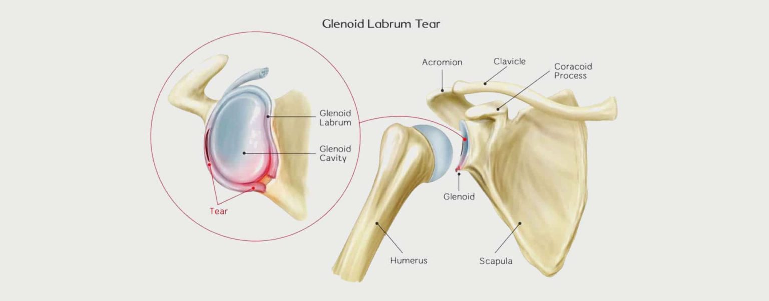 Shoulder Labral Tear Motus Physical Therapy