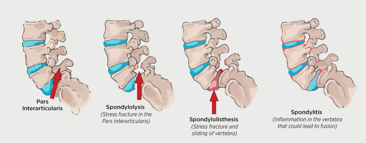 SPONDYLOSIS – SPONDYLOLYSIS – SPONDYLOLISTHESIS - MOTUS Physical Therapy