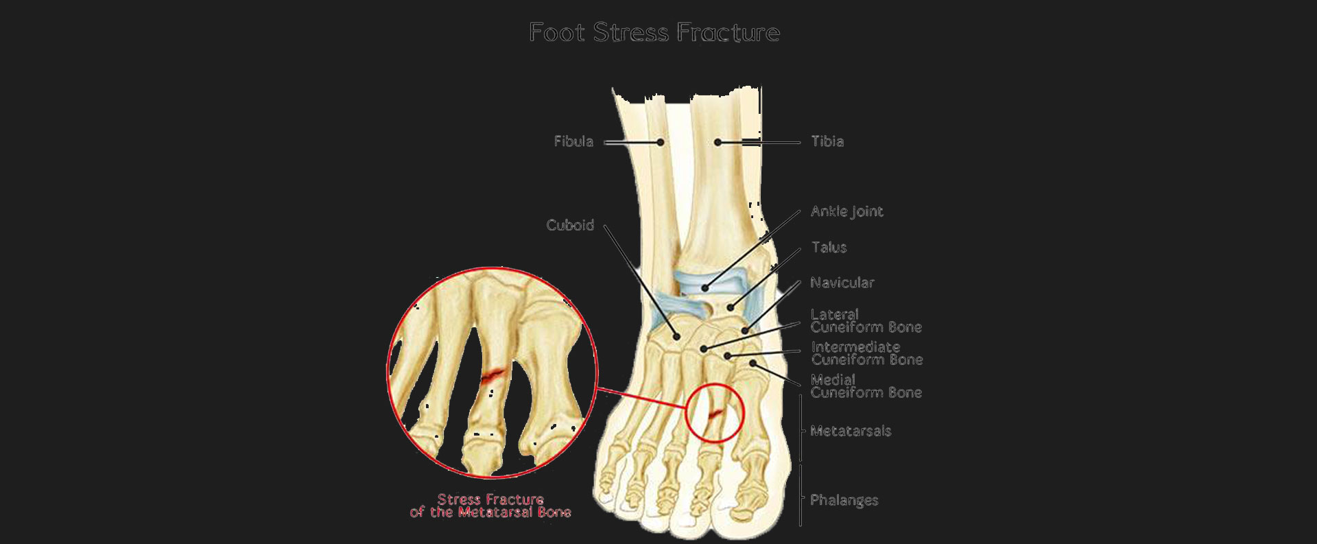 Stress-Fractures