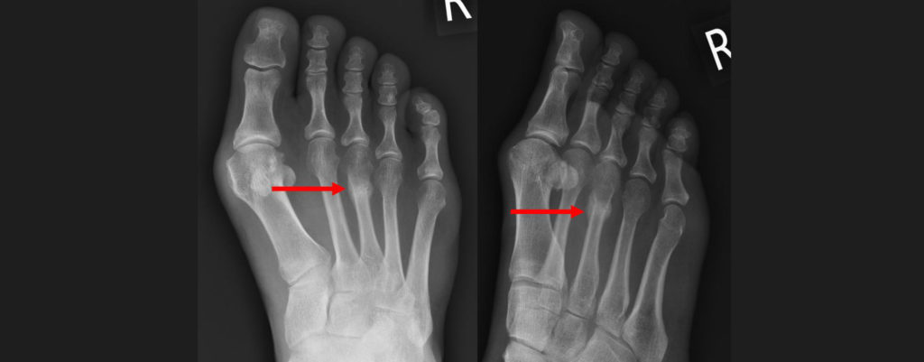 stress-fractures-old-motus-physical-therapy