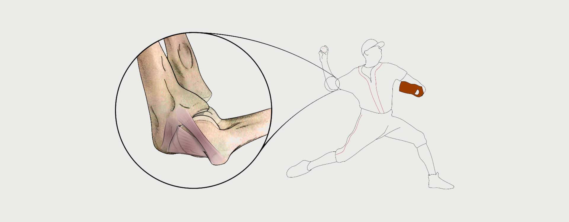 Tommy John Surgery (UCL Injury) - Motus Physical Therapy