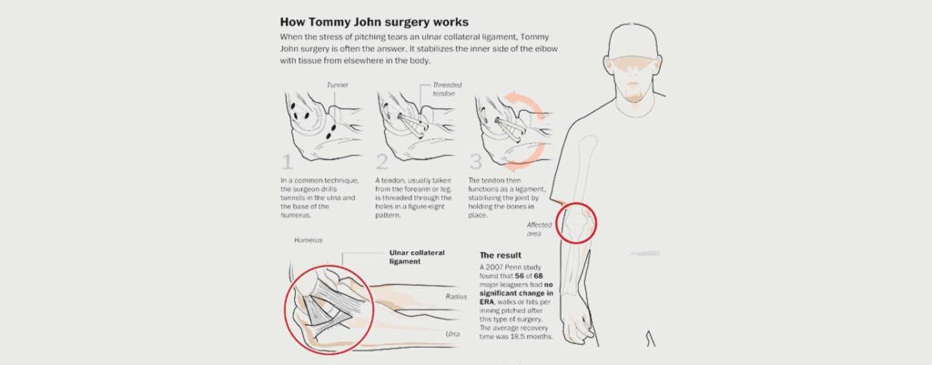 TOMMY JOHN SURGERY (UCL INJURY) - MOTUS Physical Therapy