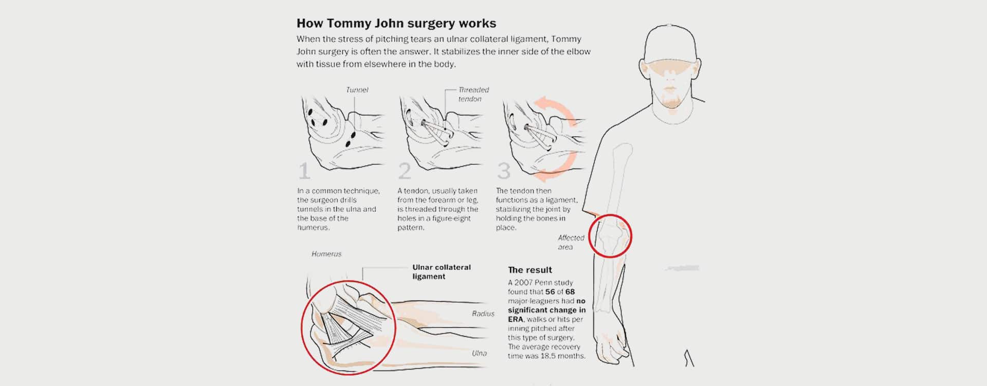 Tommy John surgery, Procedure, UCL, Baseball, & Recovery