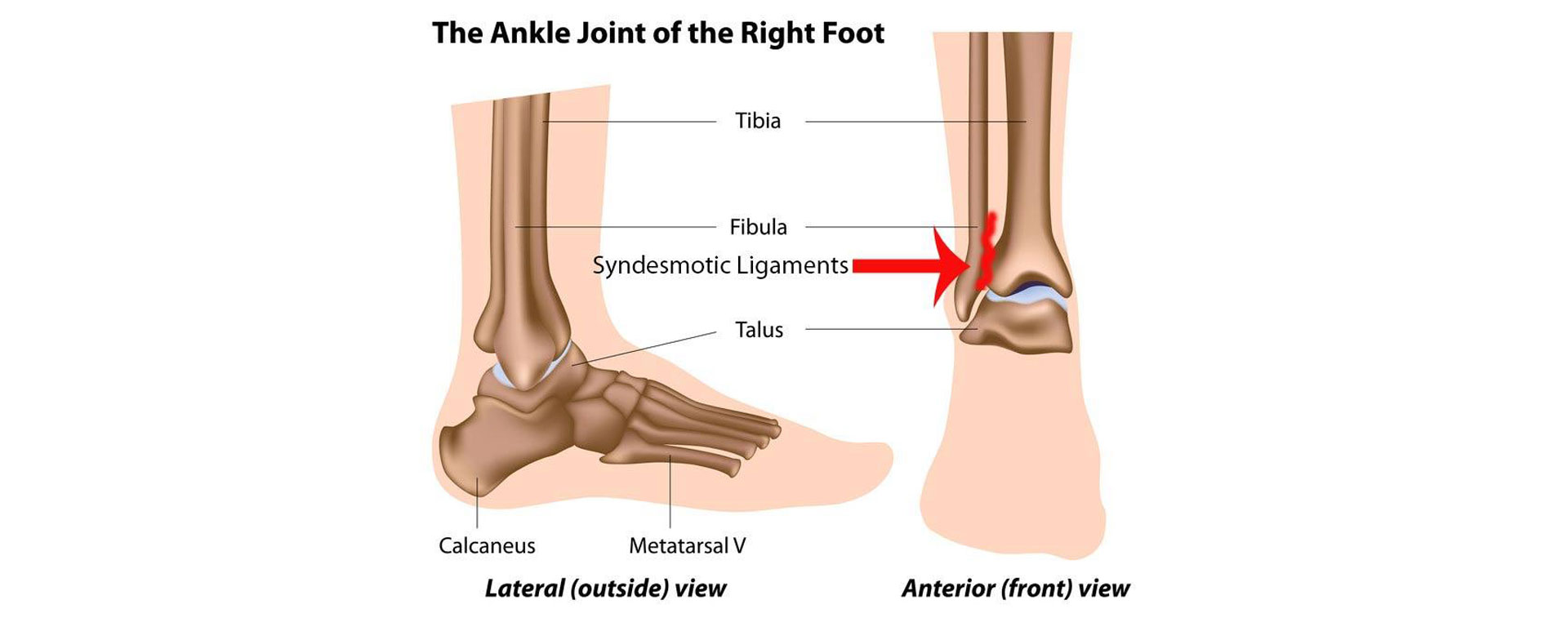 Rehabilitation of Syndesmotic (High) Ankle Sprains