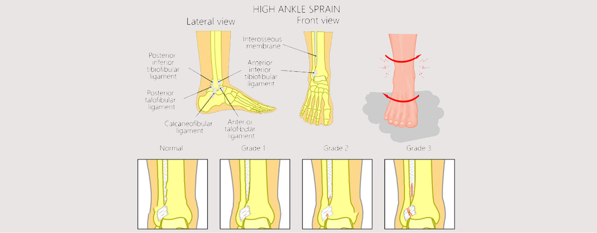 high-ankle-sprain