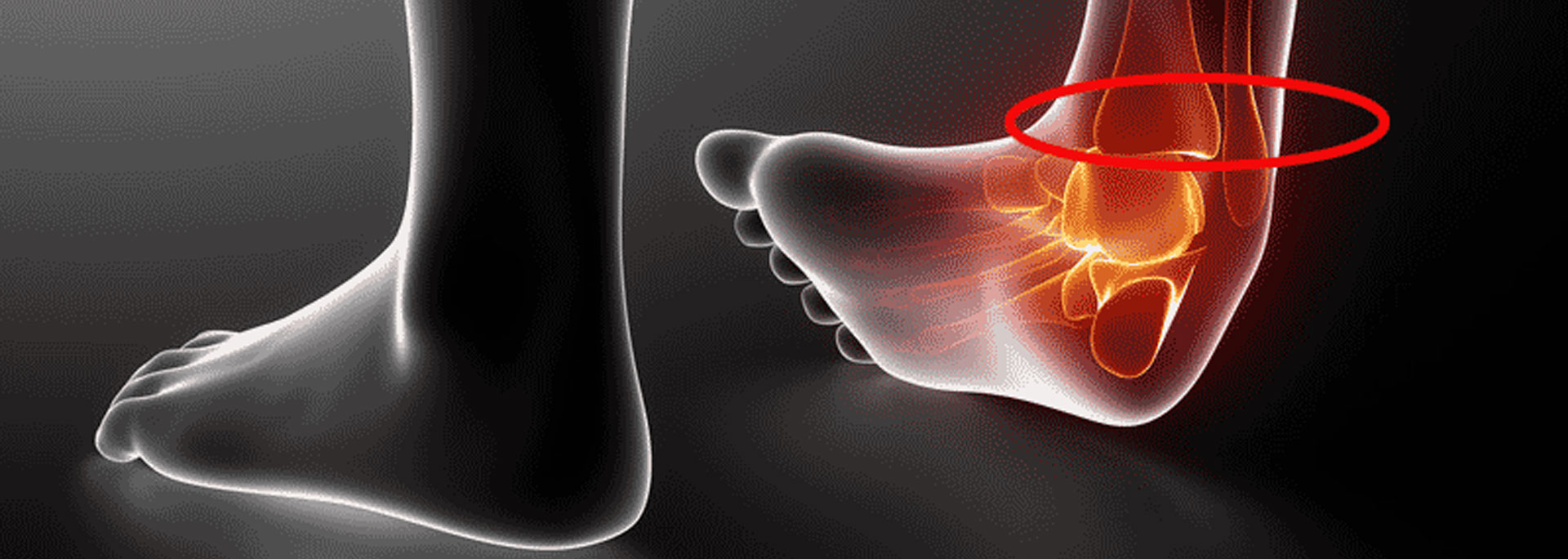 HIGH ANKLE SPRAIN - old - MOTUS Physical Therapy