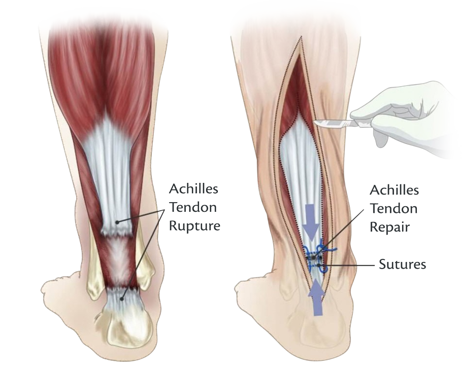 Calf Strain - Motus Physical Therapy