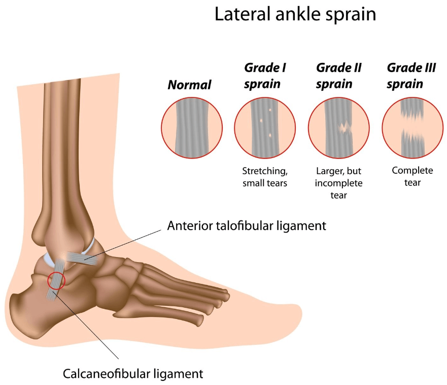 Lateral Ankle Sprain - MOTUS Physical Therapy