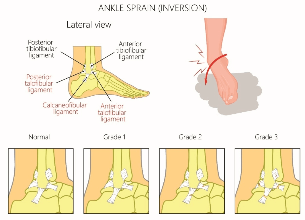 Lateral Ankle Sprain - MOTUS Physical Therapy