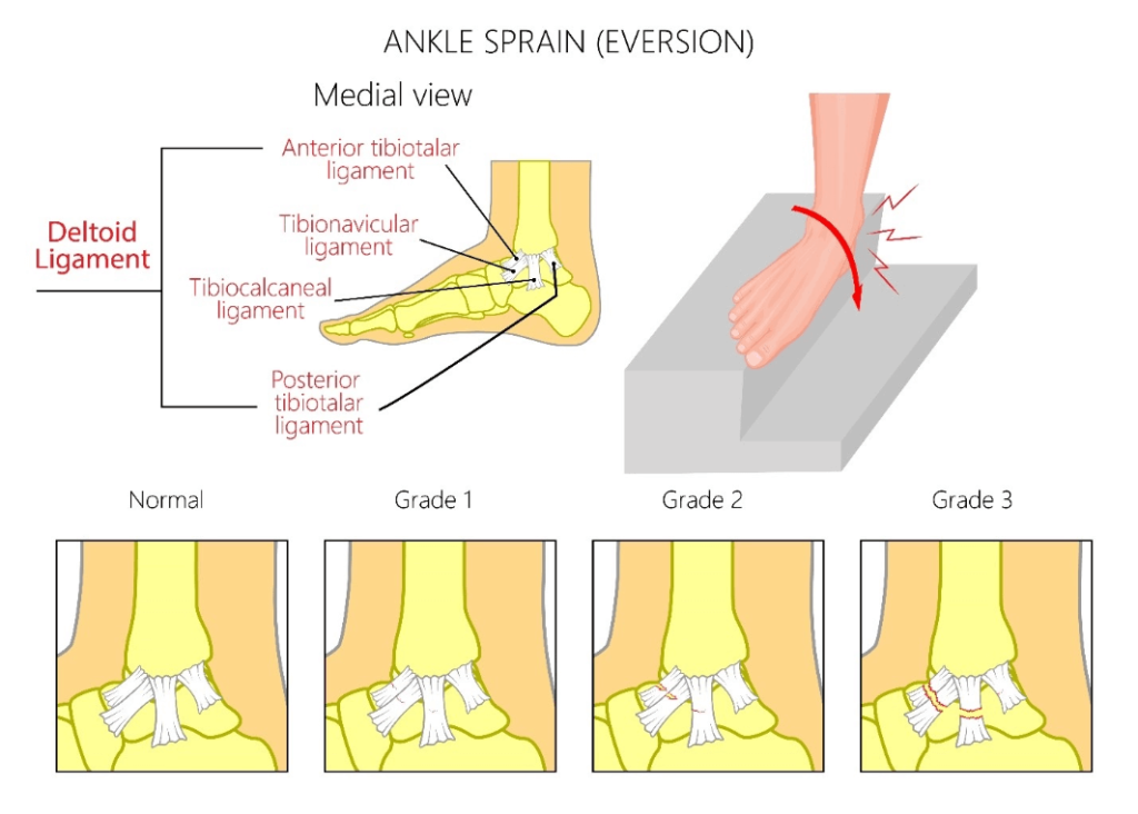 Medial Ankle Sprain Motus Physical Therapy 8282