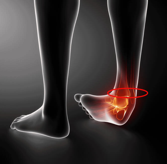 High Ankle Sprain - MOTUS Physical Therapy