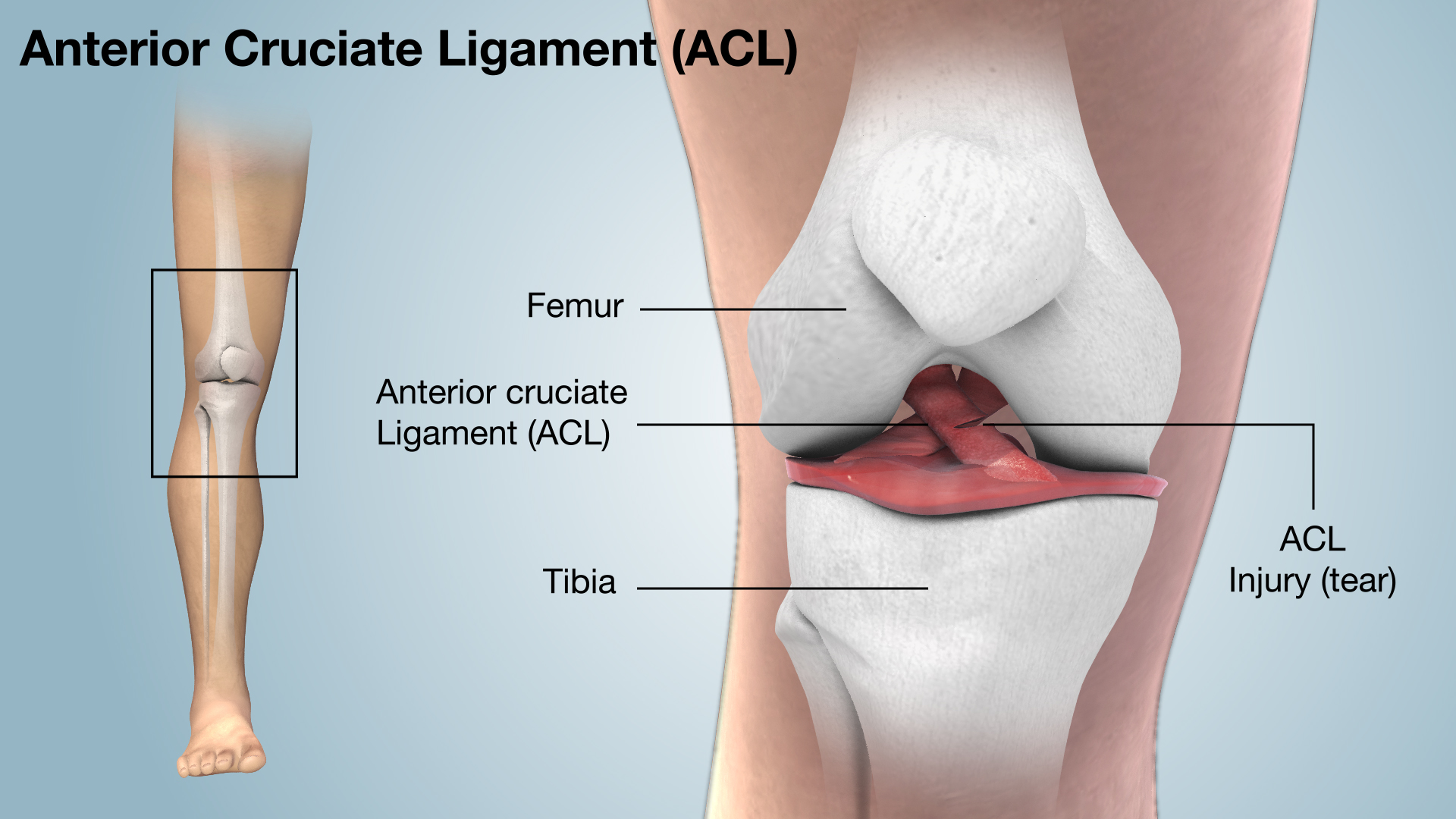 Anterior Cruciate Ligament (ACL) Tears (for Parents)