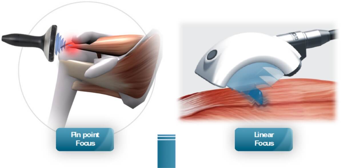Extracorporeal Shock Wave Therapy: How Does it Help Your Muscles