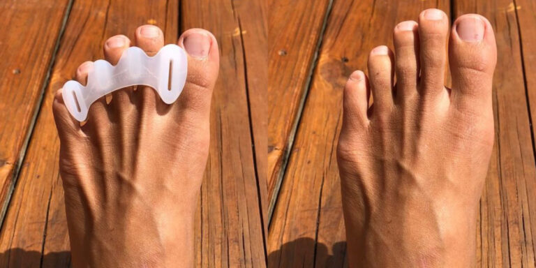 Toe Spacers Game Changing Hack Or Gimmick MOTUS Physical Therapy   CORRECT TOES Image 1 768x384 