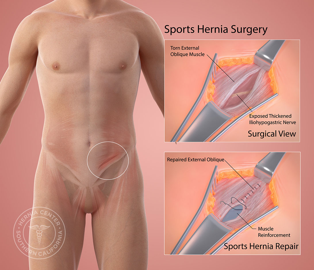 Core Muscle Injury (Sports Hernia) - Motus Physical Therapy