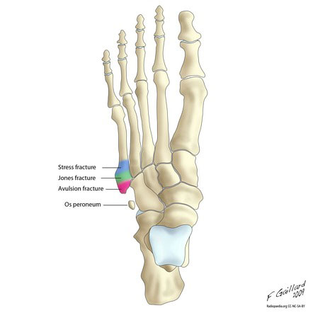 Boven hoofd en schouder Gespecificeerd Lake Taupo 5th Metatarsal Fracture - Motus Physical Therapy
