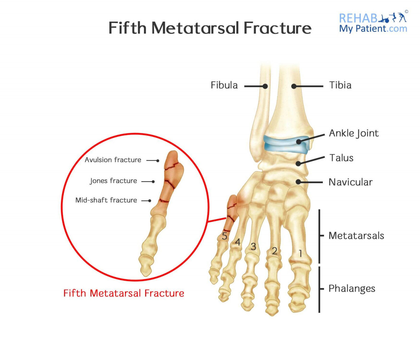 Closed Fracture Of Base Of Fifth Metatarsal Bone Of Right Foot Icd 10 ...