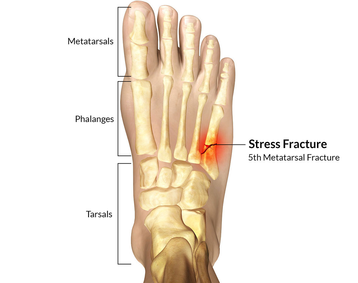 A New Classification Of Fifth Metatarsal Stress Fracture A Complete ...