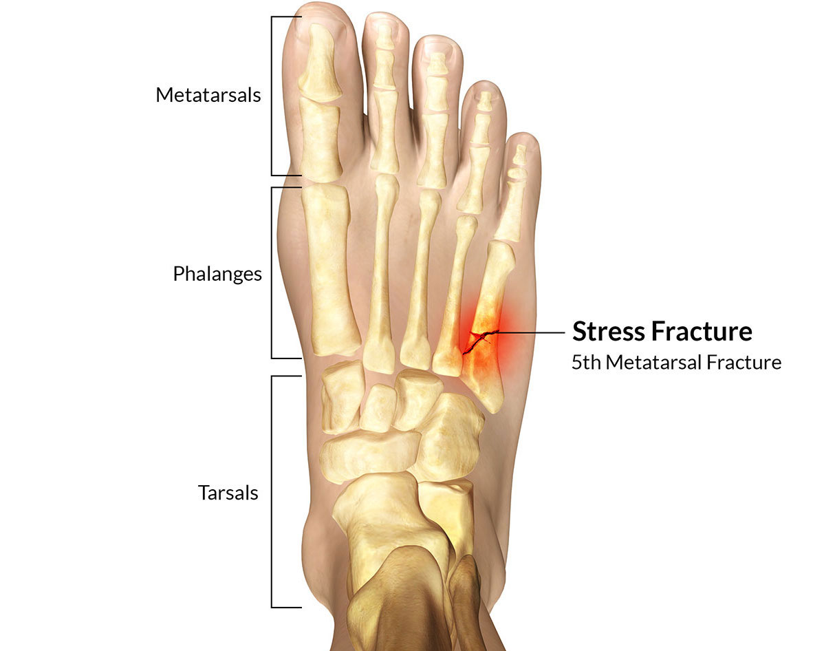 metatarsal bones fracture