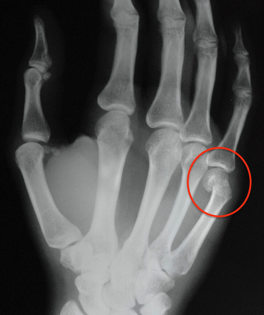 Boxers Fracture Motus Physical Therapy