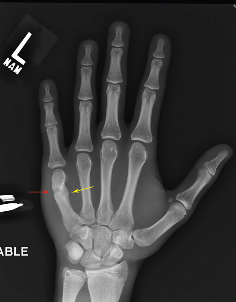 Boxer’s Fracture - Motus Physical Therapy