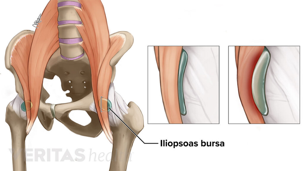 HIP BURSITIS - MOTUS Physical Therapy