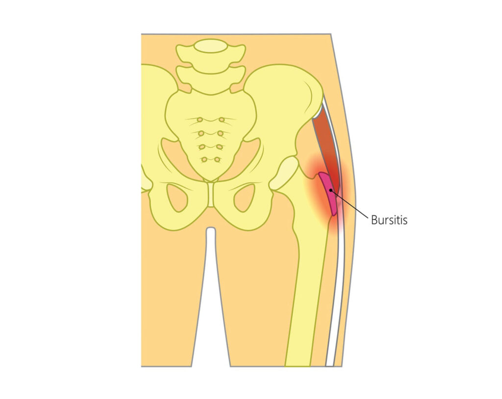 HIP BURSITIS - MOTUS Physical Therapy