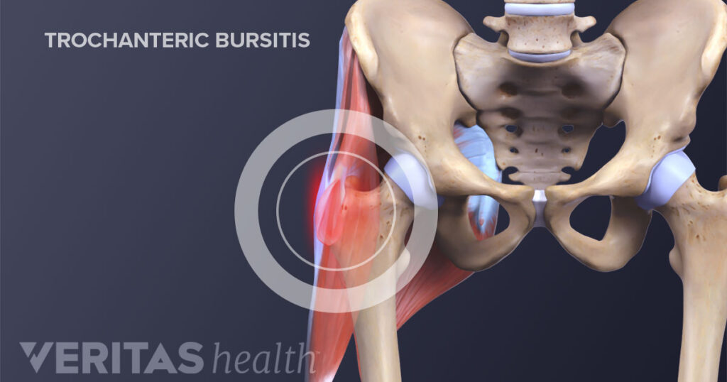 Trochanteric Bursitis - Hip - Conditions - Musculoskeletal - What We Treat  