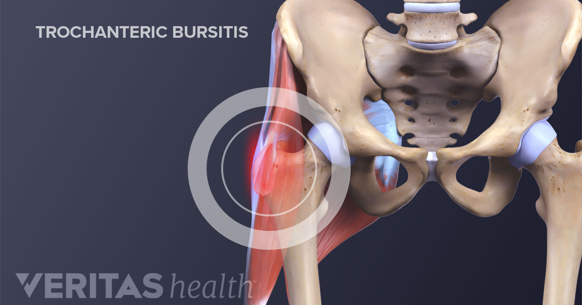 Trochanteric Bursitis, Hip Bursitis, Orthopedic Hip Specialist
