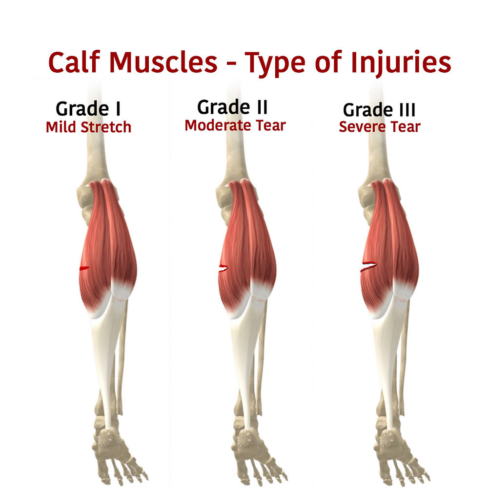 Calf Muscle Strain, Lower Extremity, Services & Treatments