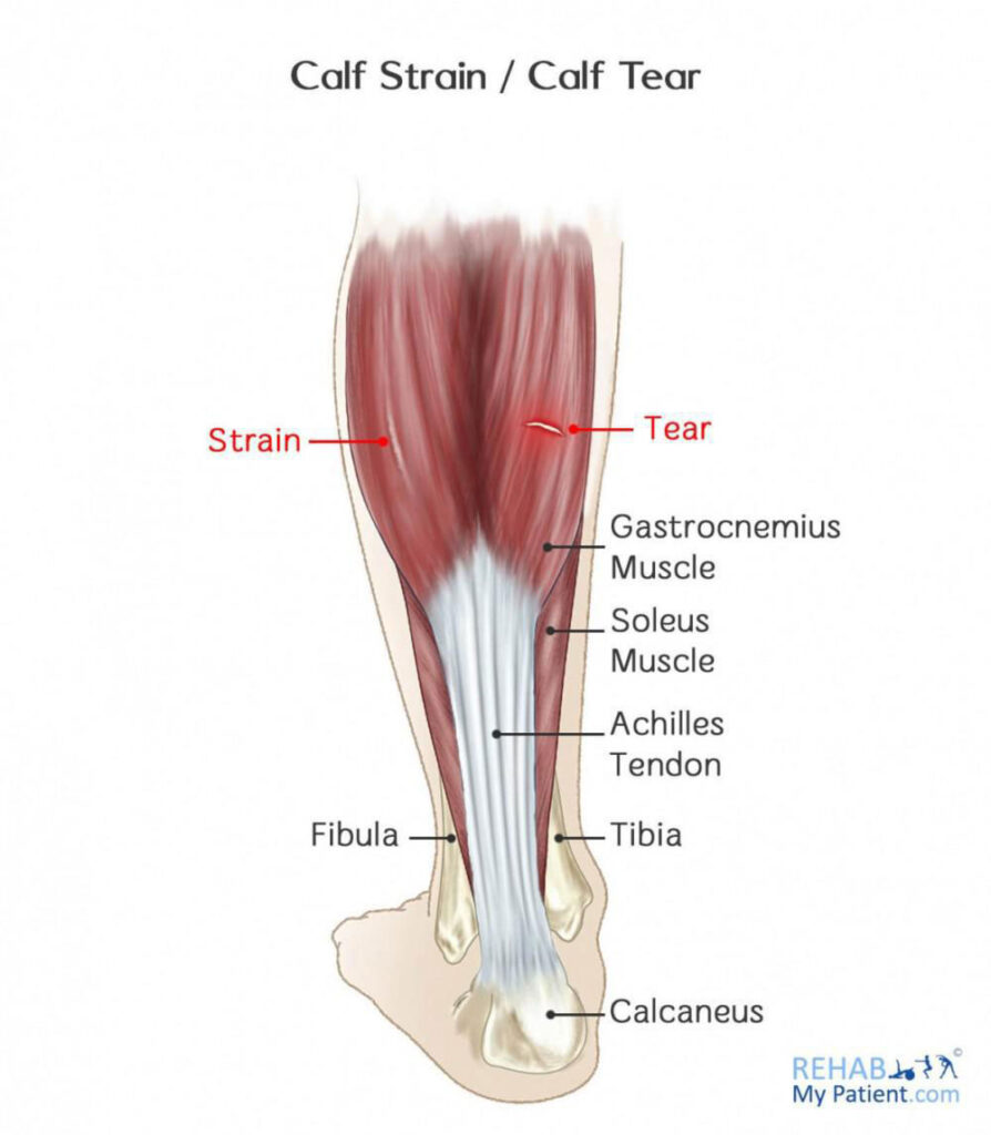Muscle Strains of The Calf  Florida Orthopaedic Institute