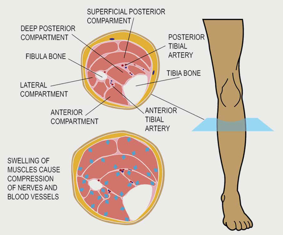 Compartment Syndrome - Motus Physical Therapy