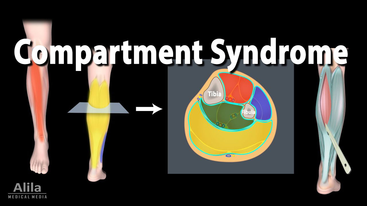 Compartment Syndrome Motus Physical Therapy