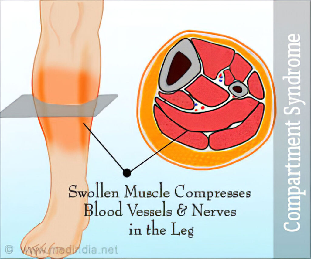 Anatomy And Compartments Of The Left Leg (Compartment Syndrome