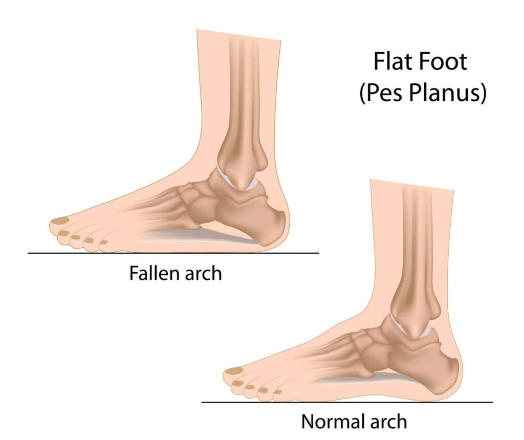 Developing on sale flat feet