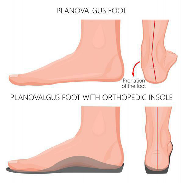 Normal neutral healthy foot compare with flat foot or fallen arch problem  with Foot print to show how entire sole of the foot to touch the floor when  stand up. Stock Photo