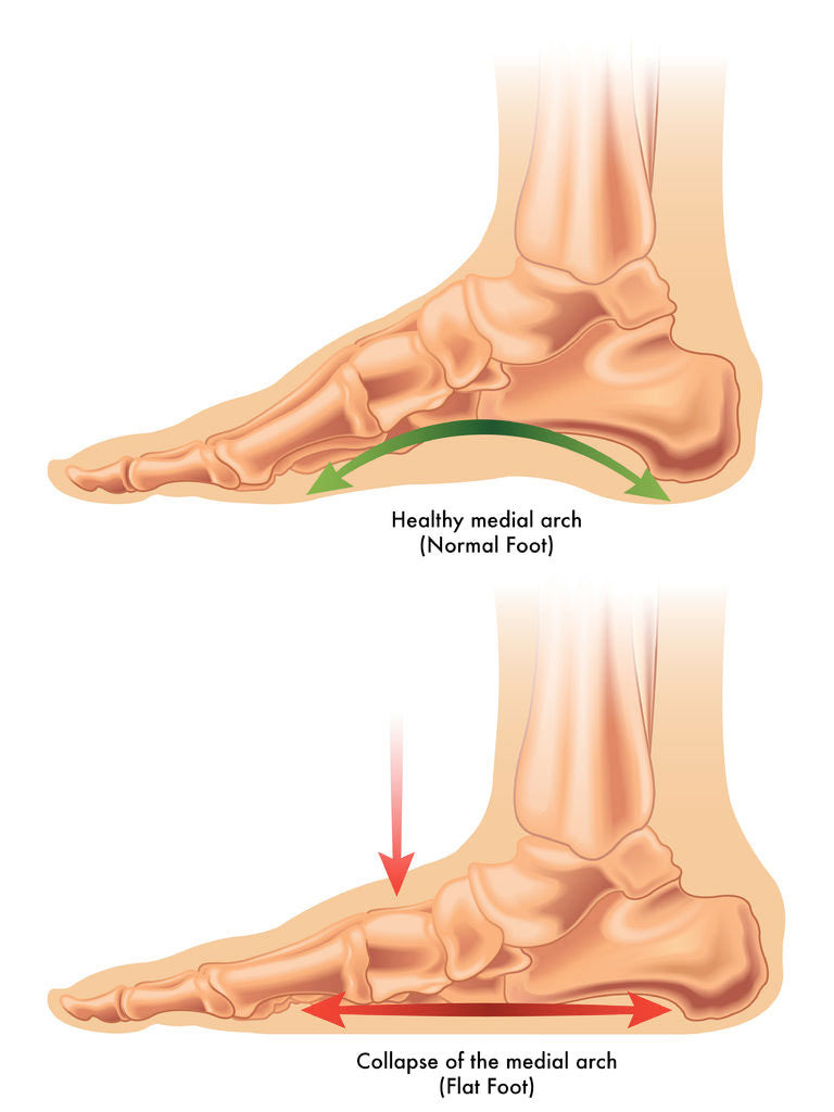 Orthotic devices sale for flat feet