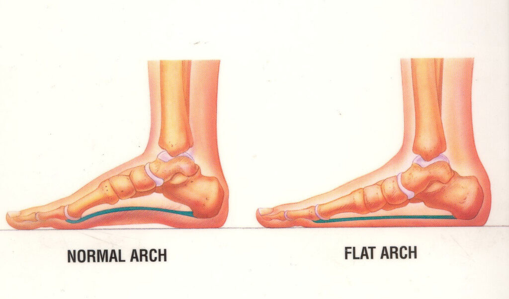 Type of flat on sale foot