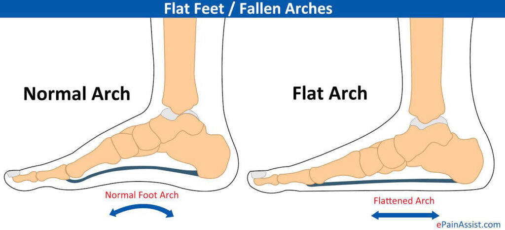 Flat Feet - Motus Physical Therapy