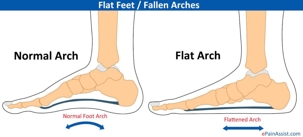 Types of flat on sale feet