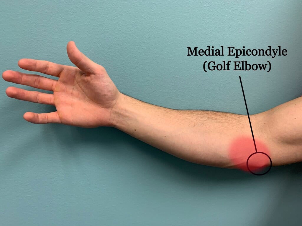 Golfer’s Elbow (Medial Epicondylitis) Motus Physical Therapy