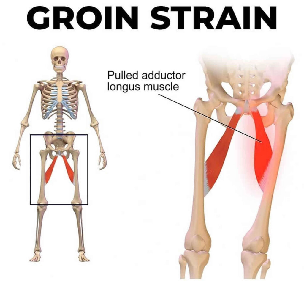 Groin Strain Motus Physical Therapy