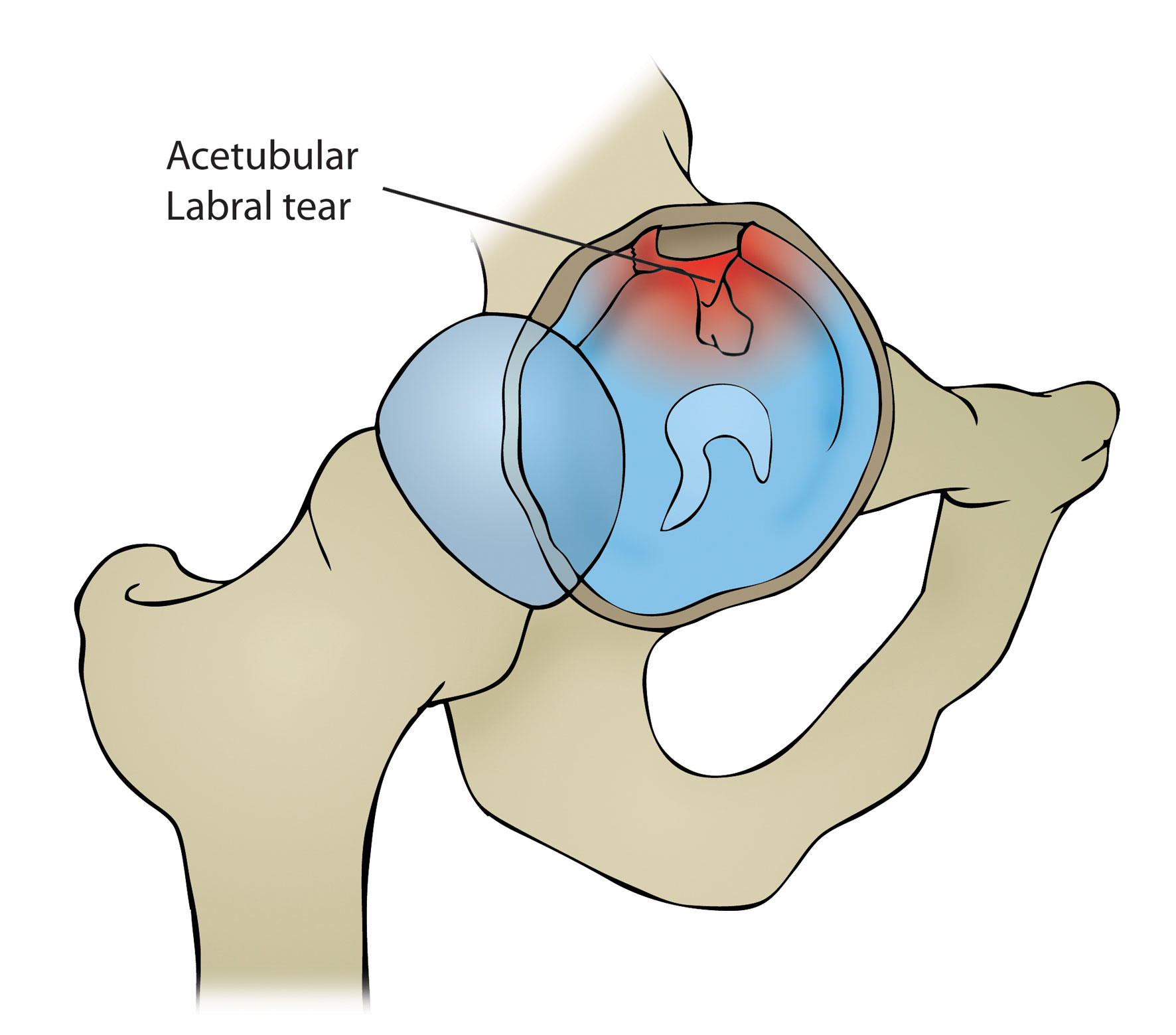 Hip Labral Tear Motus Physical Therapy