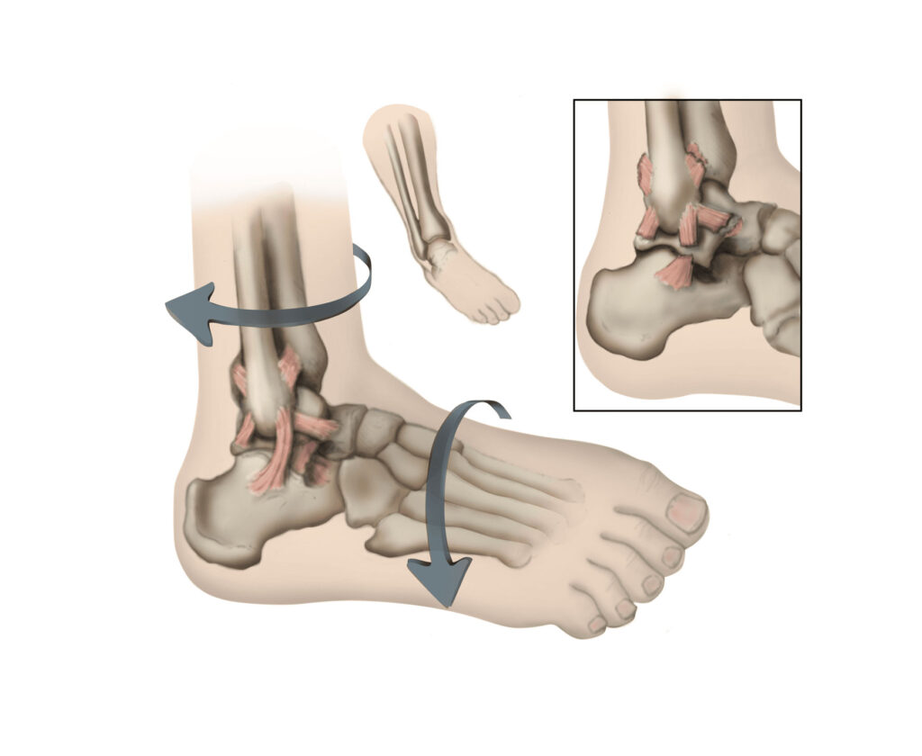 Lateral Ankle Sprain - Motus Physical Therapy