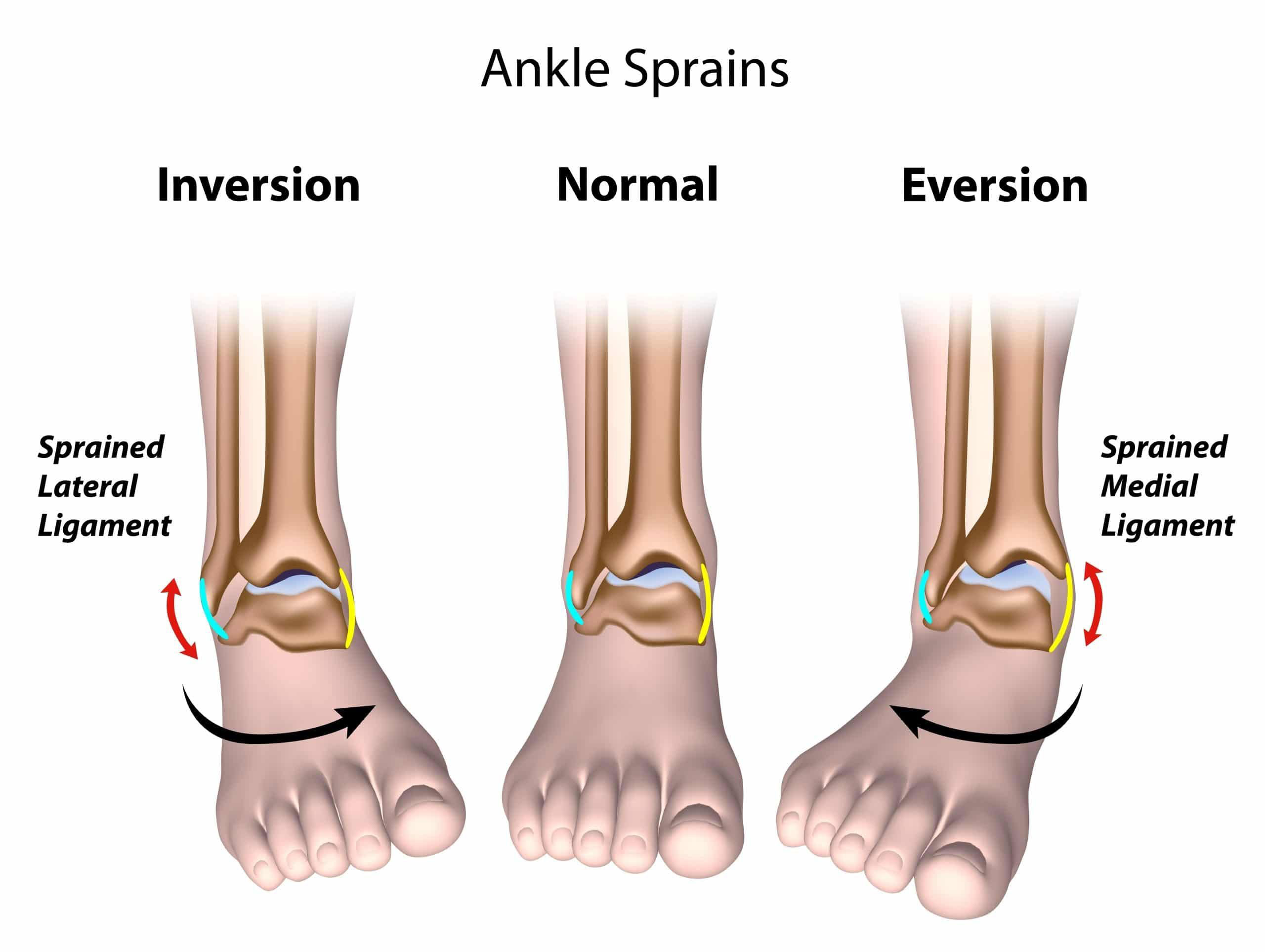 Chronic Ankle Instability, Recurrent Lateral Sprains (Strength, Plyometrics