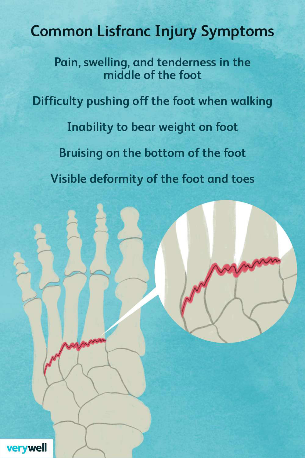 Lisfranc Fracture - Motus Physical Therapy