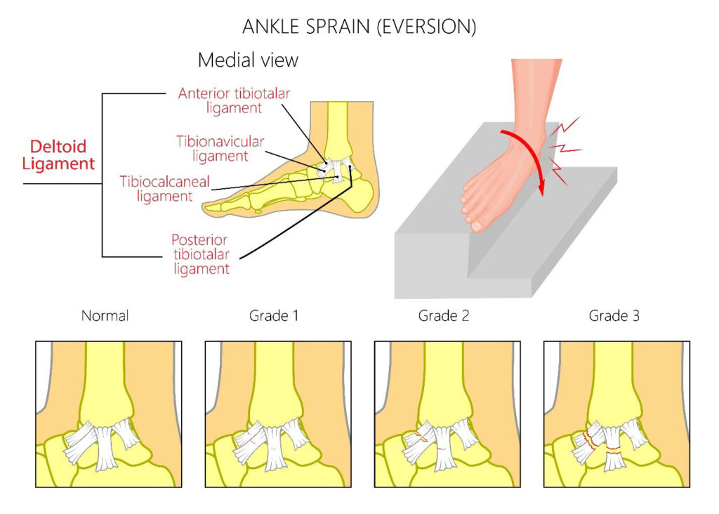 grade 1 ankle sprain swelling