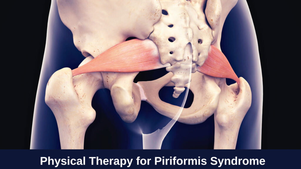 Piriformis Syndrome - Motus Physical Therapy