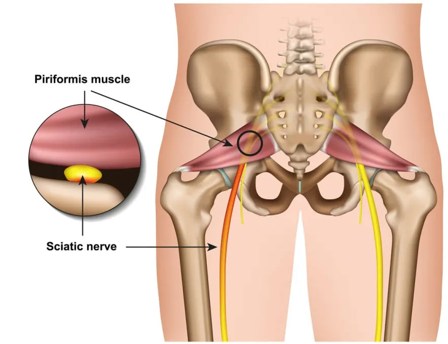 Piriformis Syndrome - Motus Physical Therapy