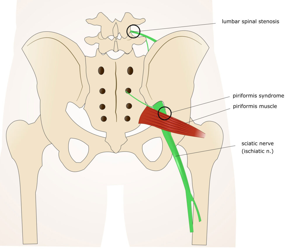 Relieve Piriformis Syndrome With Chiropractic Care â‹† Injury